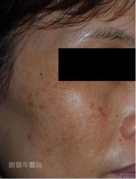 面上有黑斑|黑斑 (Melasma)